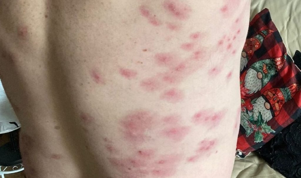 Eşek arısı sürüsü tarafından 240 sefer sokuldu: ‘Bilincim gidip geliyordu…’