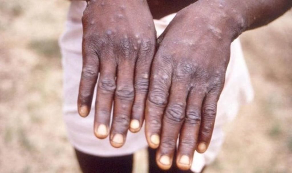 Güney Afrika’dan M çiçeği açıklaması