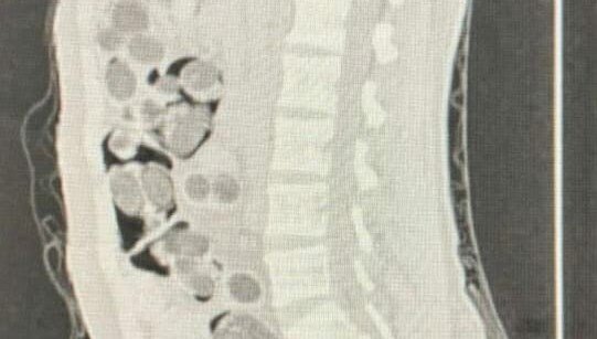 Yabancı uyruklu yolcunun midesinden 219 paket uyuşturucu çıktı