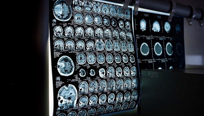 Kanseri erken teşhiste yapay zakadan yüzde 90’lık başarı oranı