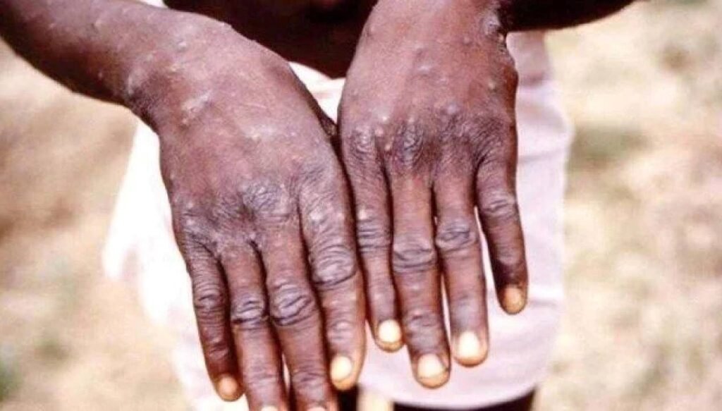 Gana’da M çiçeği yayılıyor