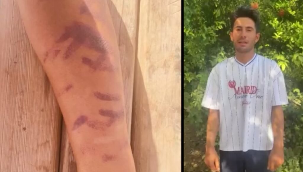 Lazer epilasyon yaptırdığı merkezde kabus yaşadı: “Ben yandım başkaları yanmasın”